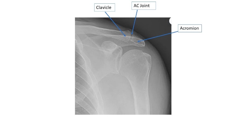 Clavicle arthritis x ray by Orthopaedic Associates of Muskegon