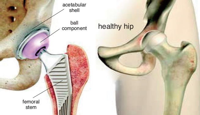 What is an anterior hip replacement?