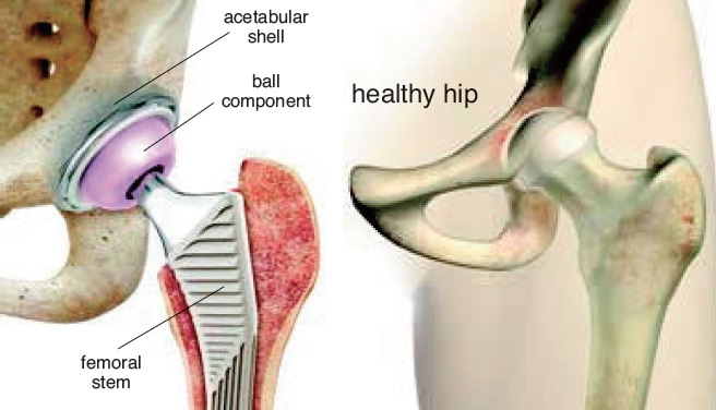 What should you expect during a full hip arthroplasty?