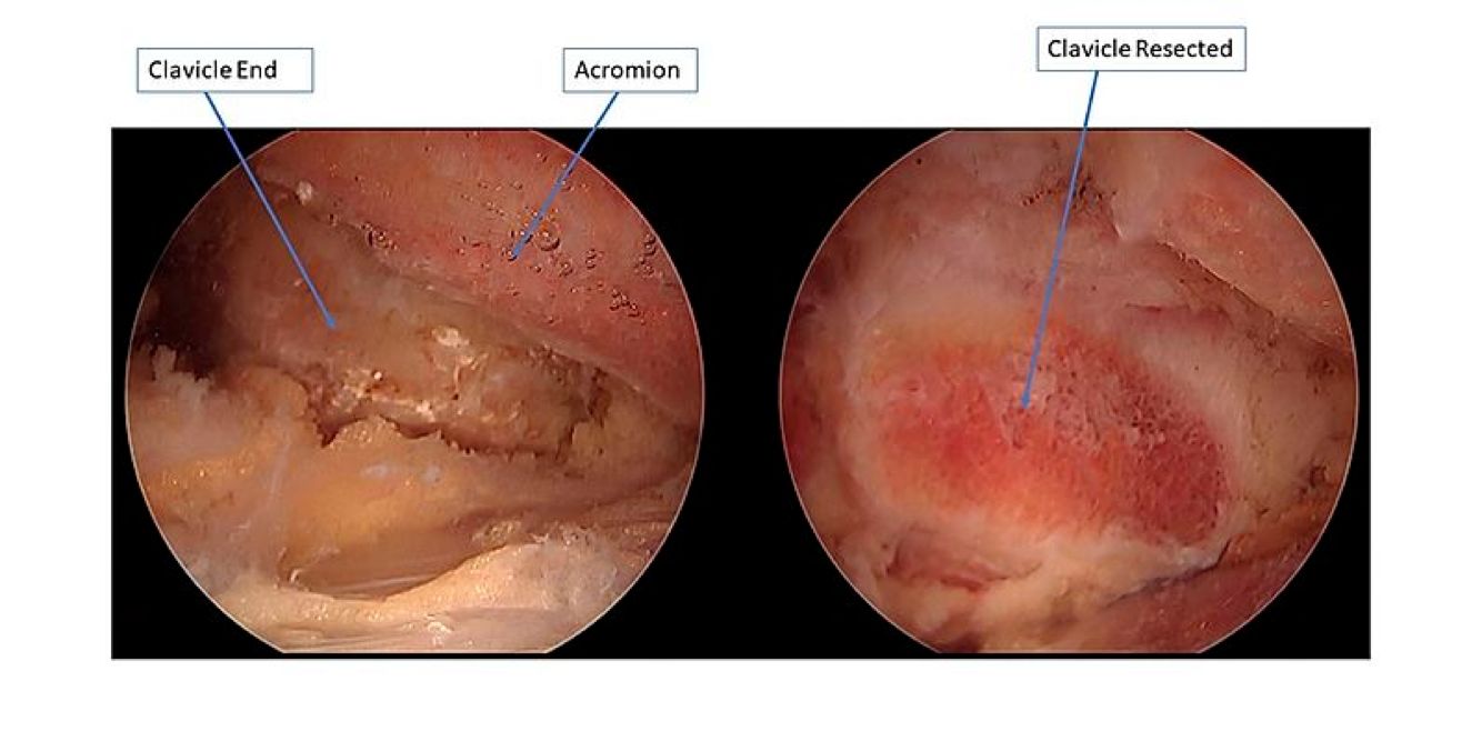 arthroscopic-images-before-and-after-distal-clavicle-resection