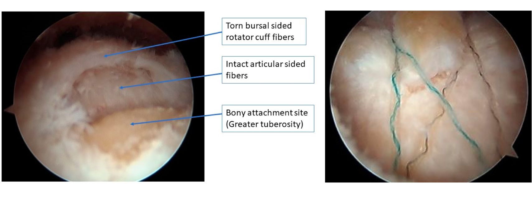 arthroscopic-images-of-a-partial-bursal-sided-rotator-cuff-tear.jpg