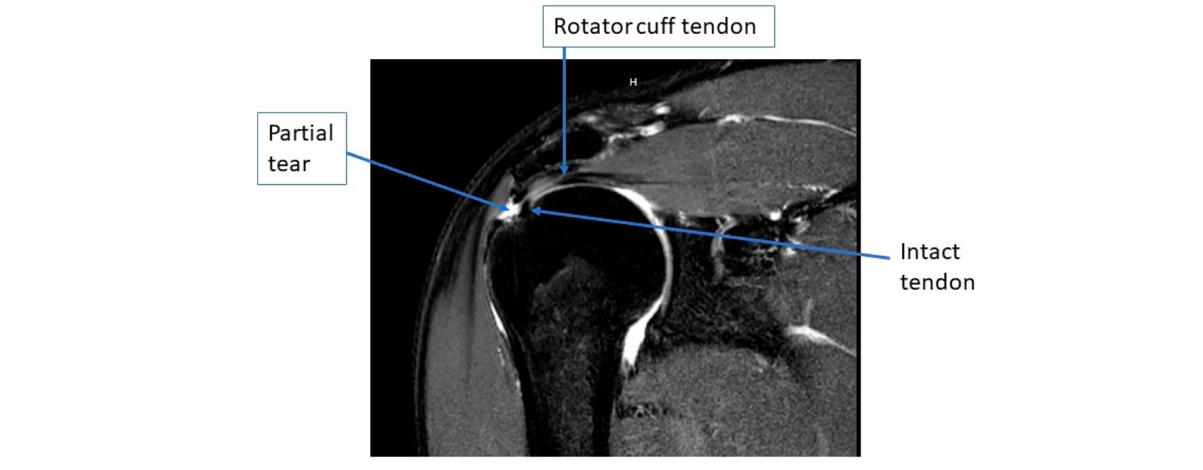 mri-image-of-a-partial-thickness-rotator-cuff-tear.jpg