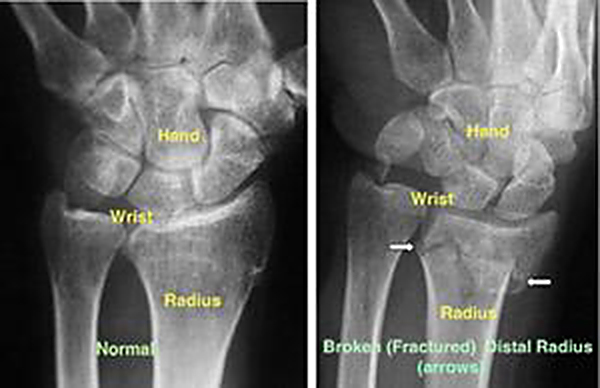 Distal-Radius-Fracture