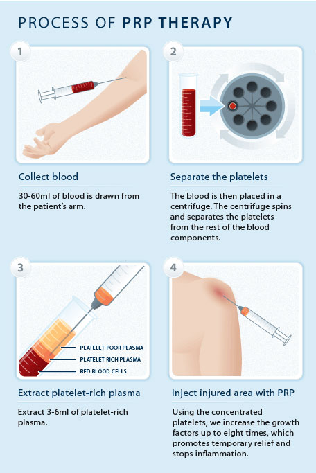 Platelet-Rich Plasma (PRP) Therapy diagram