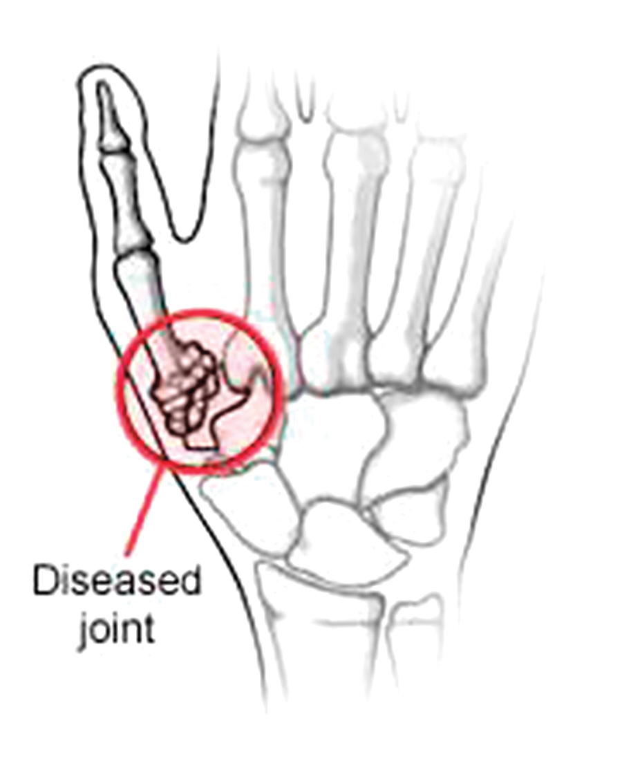 Thumb-Arthritis-1st-CMC