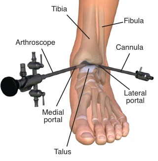 ankle-arthro