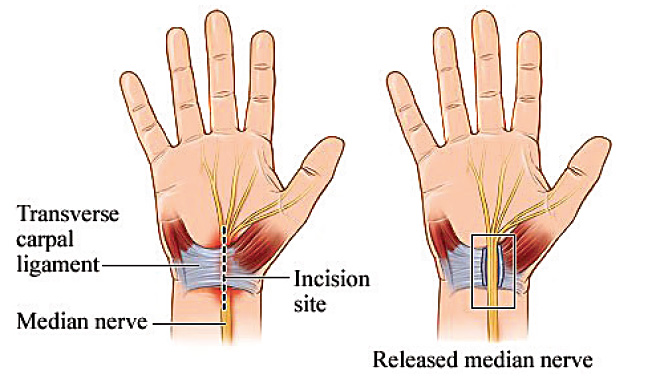 carpal-tunnel-release-surgery