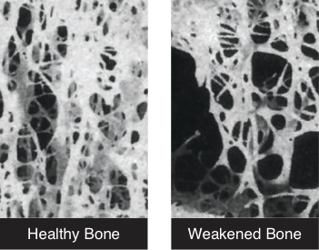 healthy-weak-bone