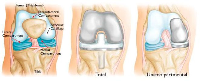 Knee Treatment In Muskegon &amp; Grand Haven, Mi | Orthopaedic Associates Of  Muskegon