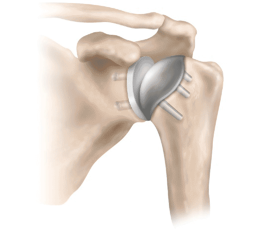 Shoulder Treatment in Muskegon & Grand Haven, MI | Orthopaedic ...