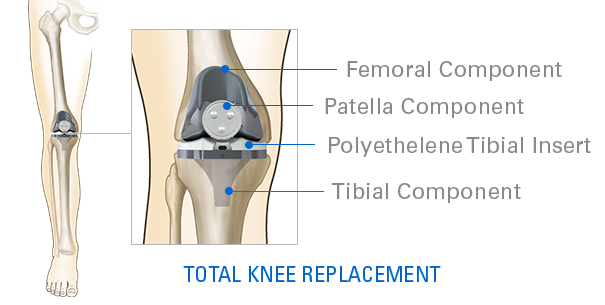 total-knee-replacement