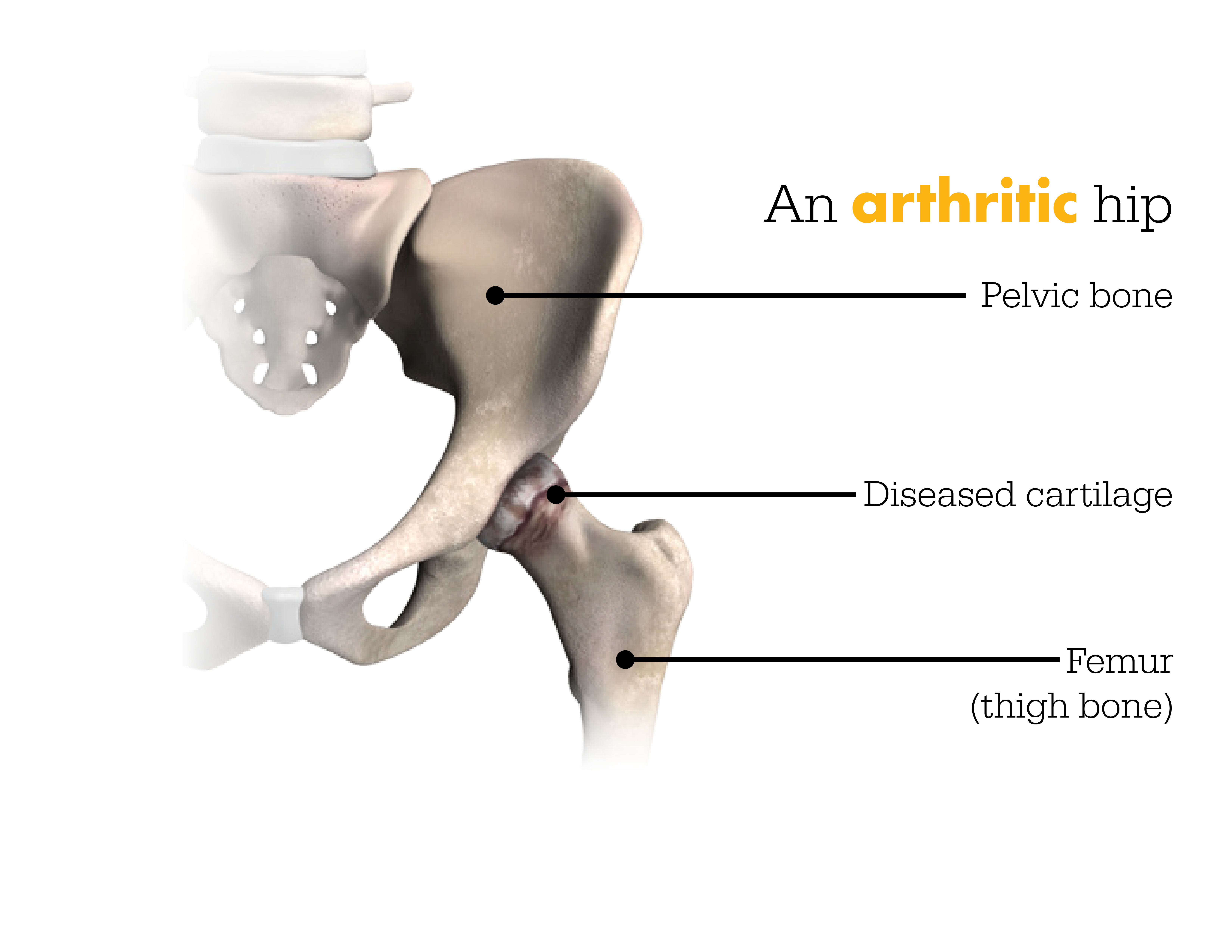 Arthritic hip diagram