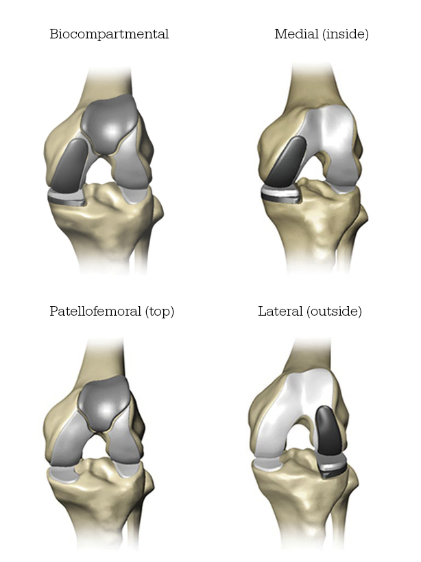 partial-knee-intro