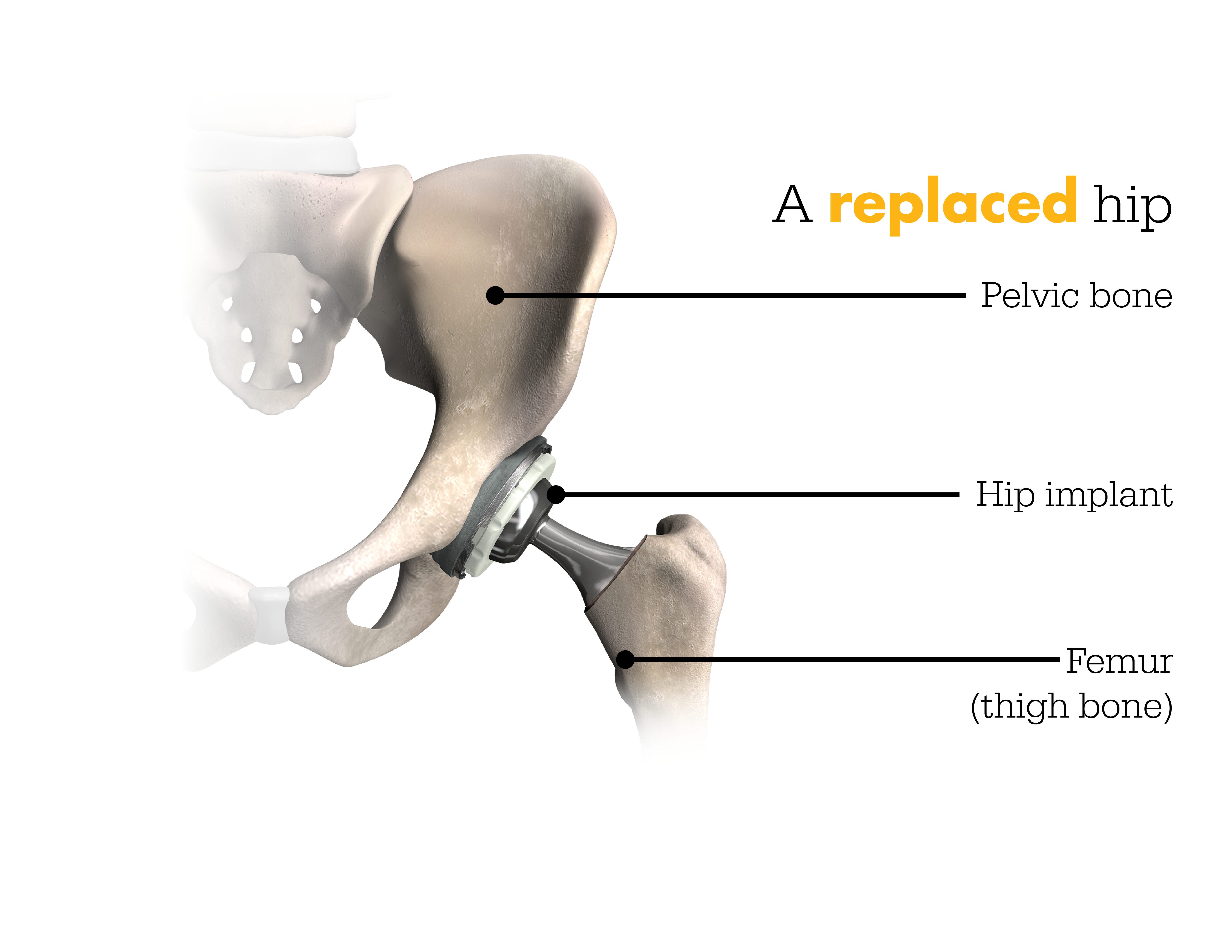 replaced-hip