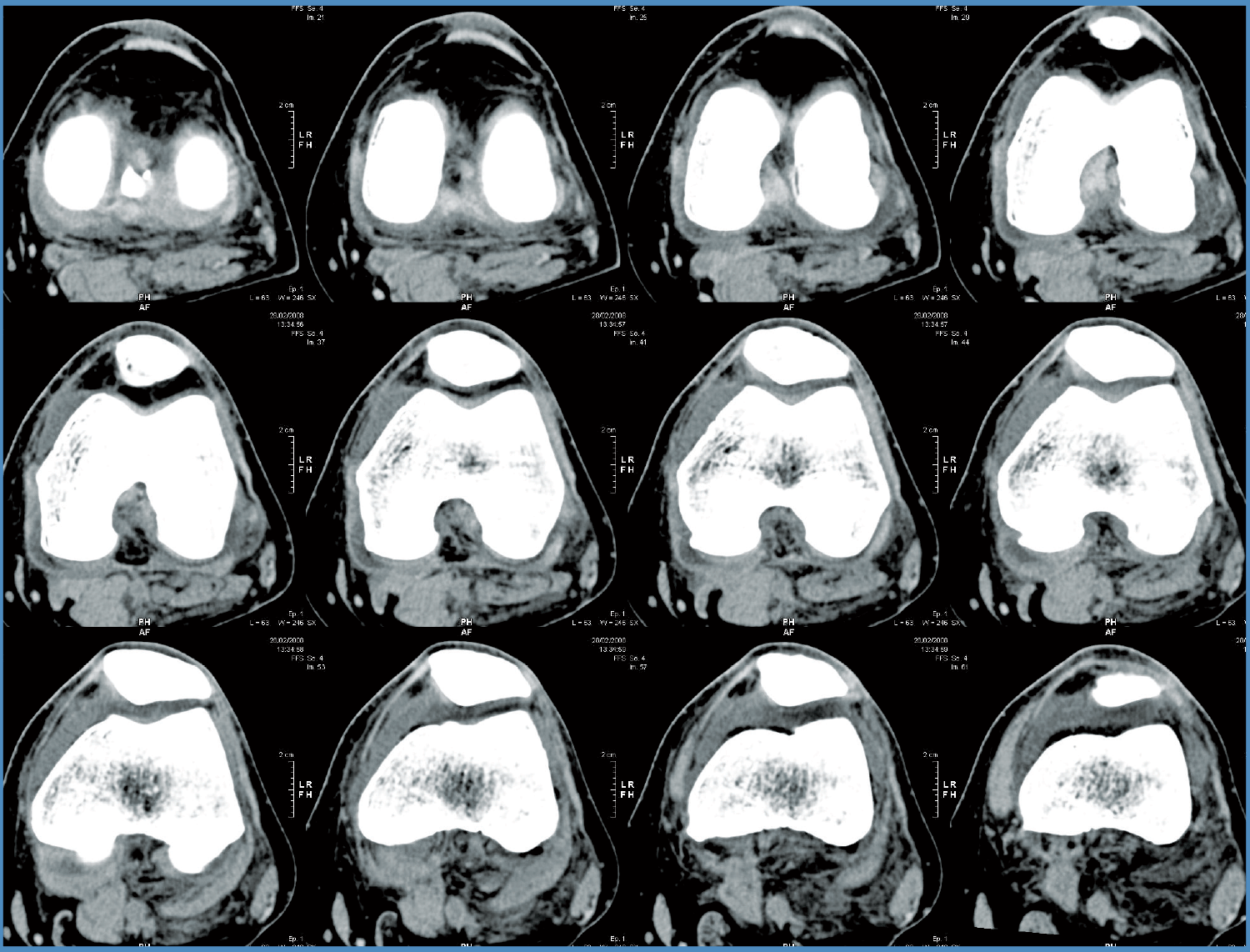 CT scan of total knee