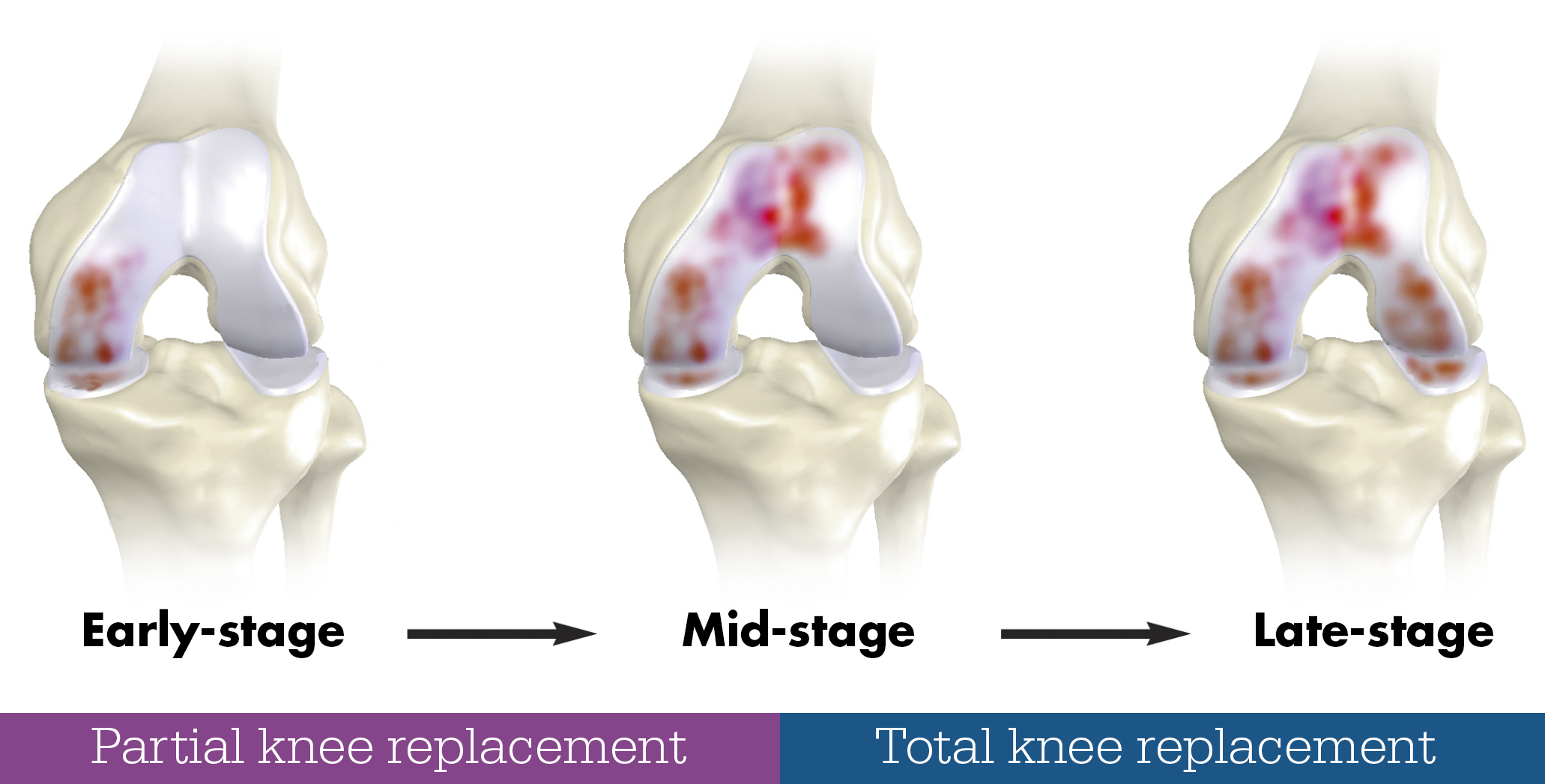 total-partial-knee-stages