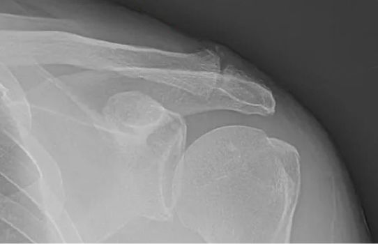 Distal Clavicle Surgery