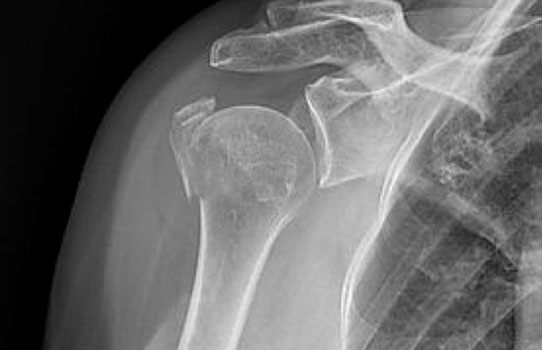 Shoulder Trauma and Fractures